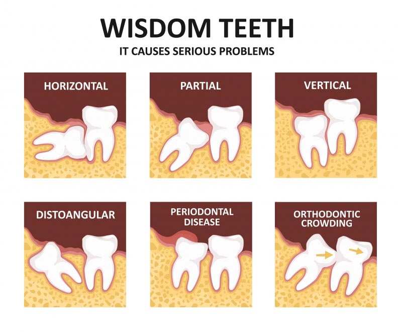 Are Wisdom tooth extractions necessary