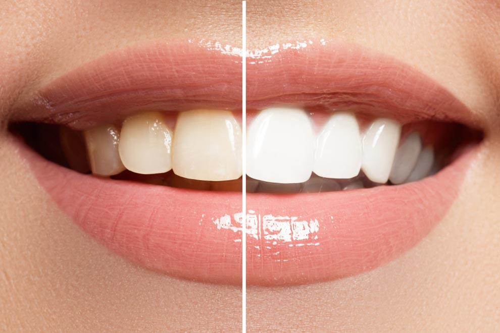 Can whitening toothpaste harm your teeth