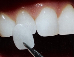 Brighten Your Smile This Summer with Veneers