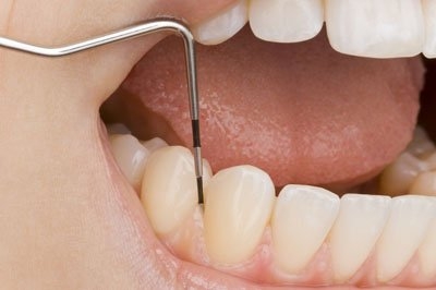 The Damaging Effects of Plaque and Tartar on Your Teeth and Gums