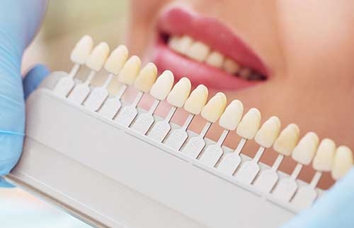 The Pros and Cons of Over The Counter Tooth Whitening Products