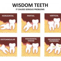 Are Wisdom tooth extractions necessary